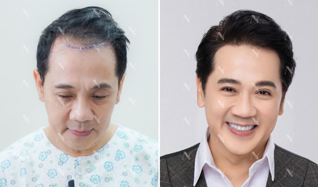 thành lộc cấy tóc tại newhair