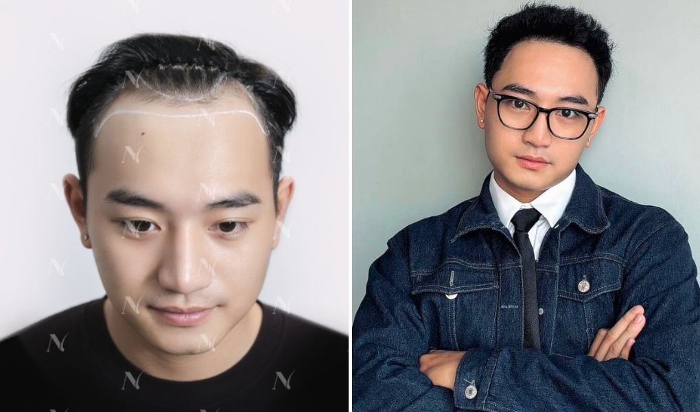 thông nguyễn tống ca cấy tóc