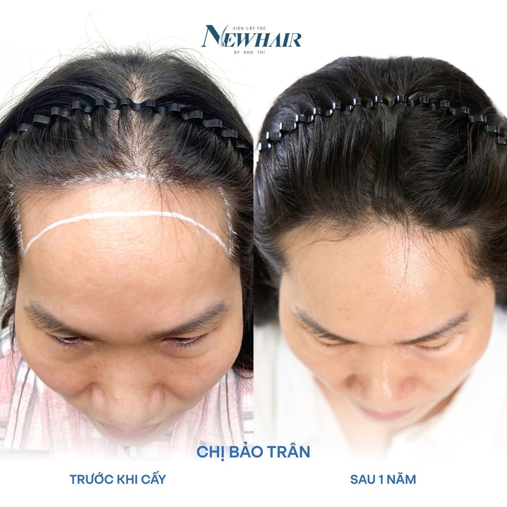 thưa đường chân tóc chị Trân