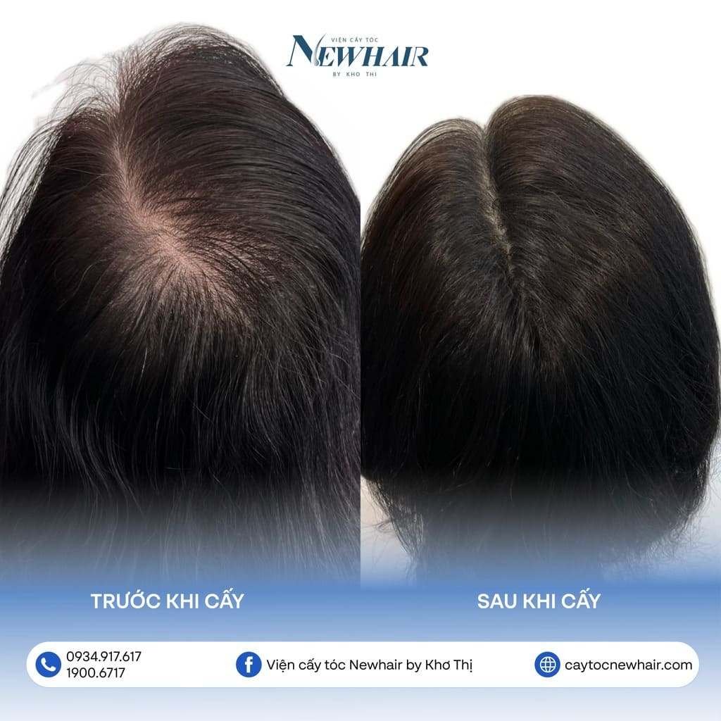 thưa đường chân tóc mẫu