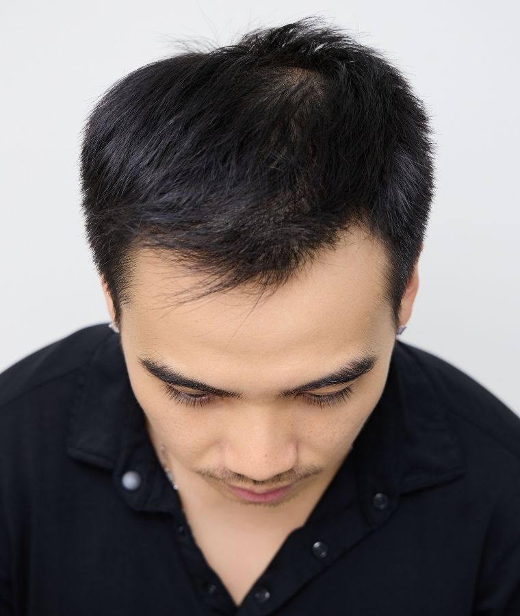 tuấn khôi sau khi cấy tóc