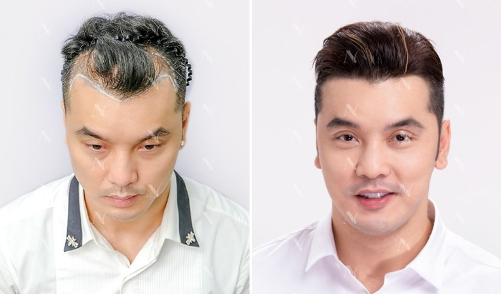 ưng hoàng phúc cấy tóc