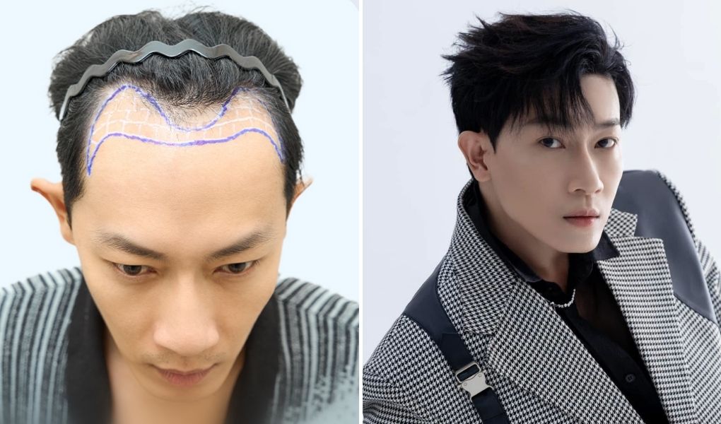 vương huy cấy tóc nam