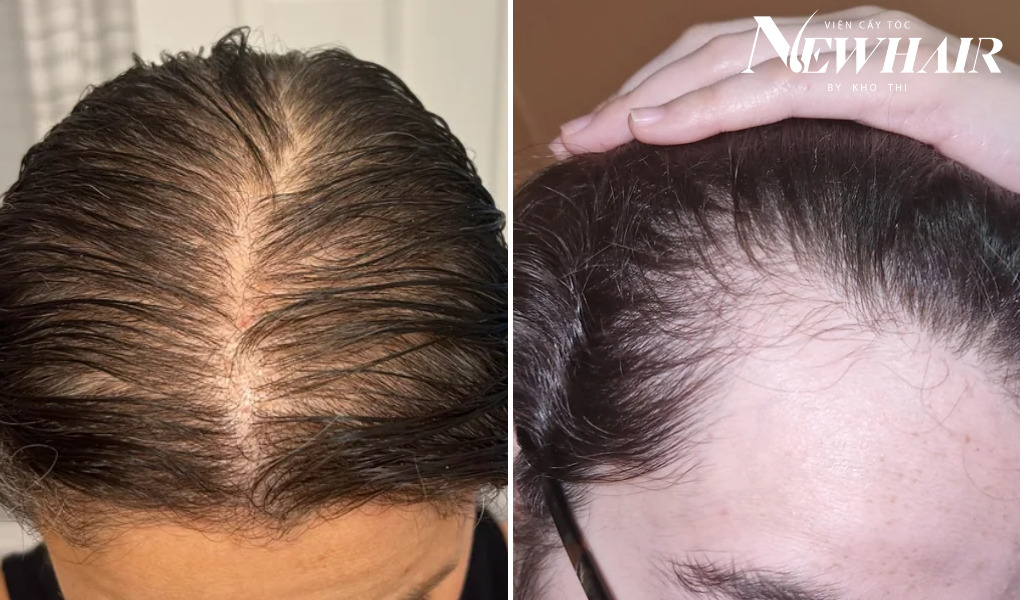 biểu hiện hói đầu ở nữ giới