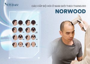các cấp độ hói ở nam giới