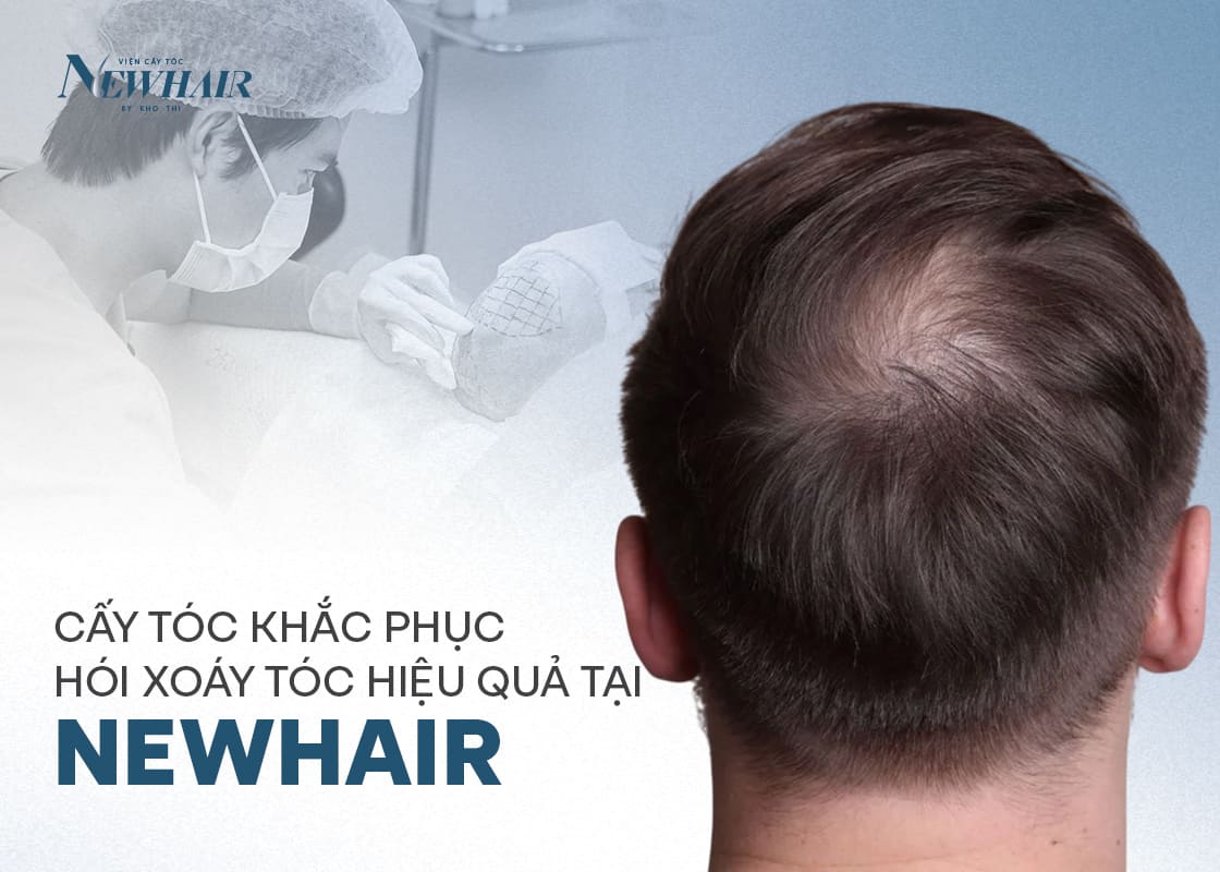 cách trị hói xoáy tóc tại viện cấy tóc newhair