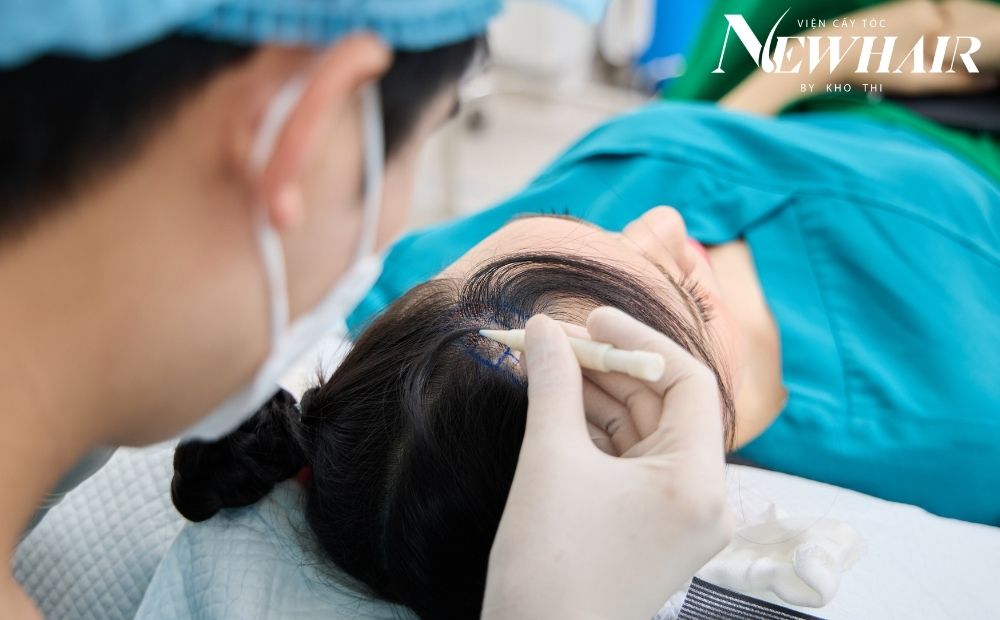 cấy tóc cho nữ che sẹo