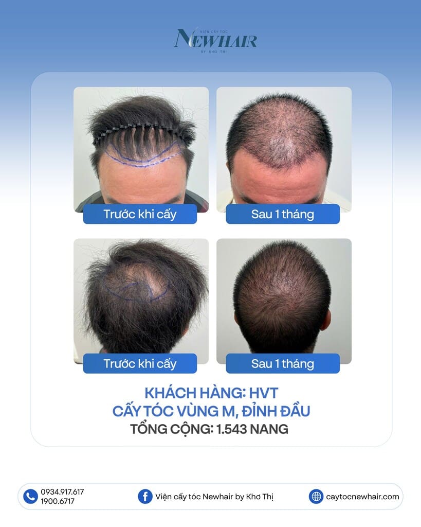 cấy tóc đỉnh đầu và vùng m 1543 nang sau 1 tháng