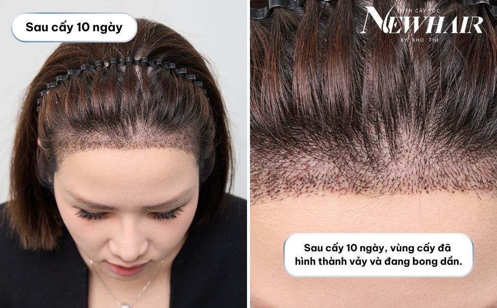 cấy tóc nữ sau 10 ngày