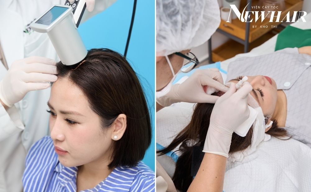 điều kiện cấy tóc nữ