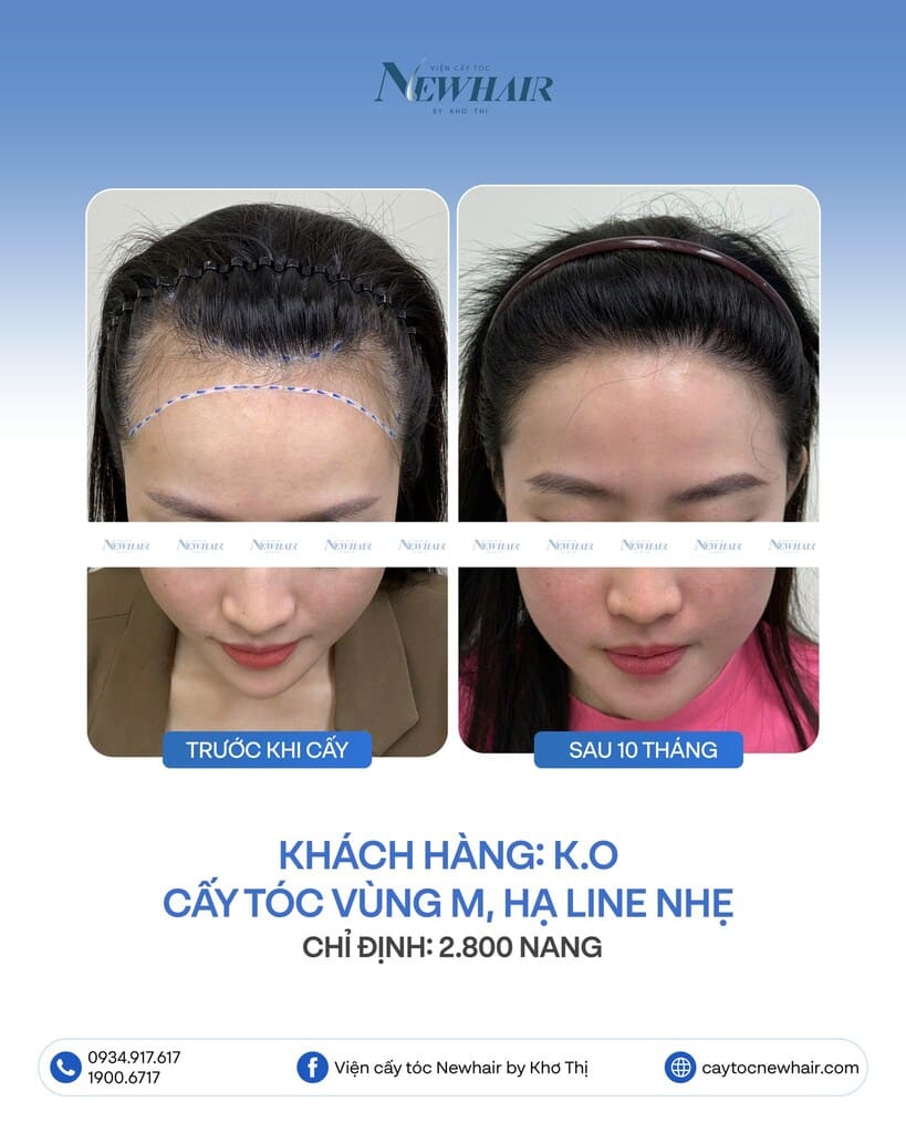 hạ line nữ 2800 nang sau 10 tháng