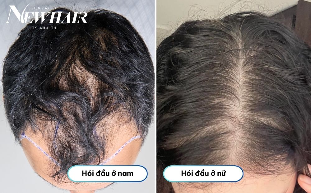 hình thái hói đầu ở nam và nữ