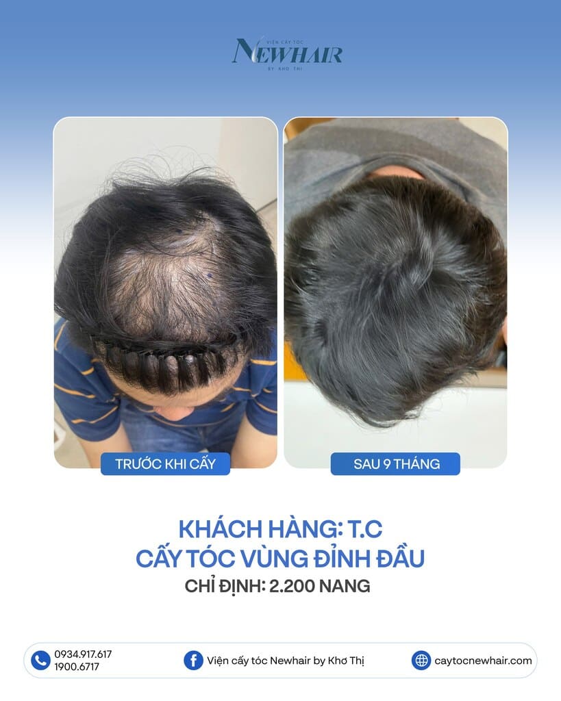 khách cấy hói xoáy tóc 2200 nang sau 9 tháng