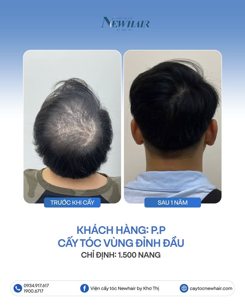 khách cấy tóc đỉnh đầu 1500 nang sau 1 năm