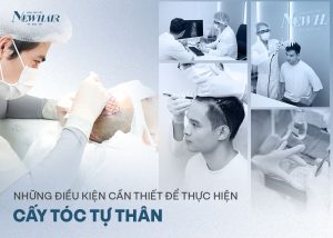 những điều kiện cấy tóc tự thân