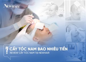 cấy tóc bao nhiêu tiền