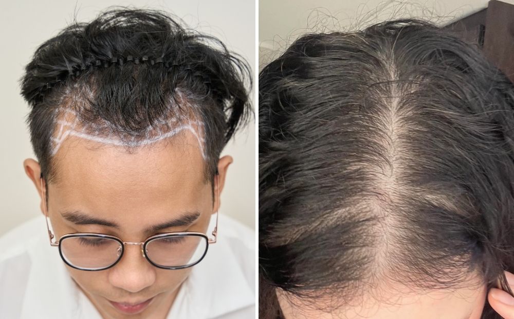 cấy tóc nam khác gì cấy tóc nữ