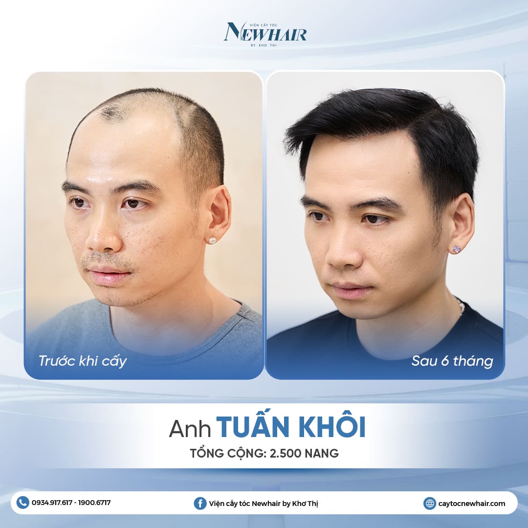 tuấn khôi trước và sau cấy tóc