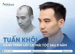 Tuấn khôi cấy tóc tại NEWHAIR