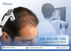 mật độ cấy tóc bao nhiêu là lý tưởng
