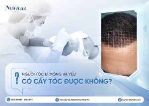 người tóc mỏng và yếu có cấy tóc được không