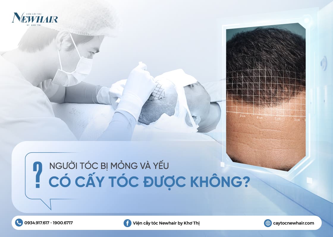 người tóc mỏng và yếu có cấy tóc được không