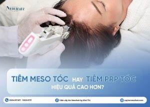 tiêm meso tóc và tiêm prp tóc
