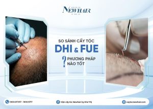 Cấy tóc DHI và FUE cái nào tốt