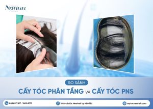 so sánh cấy tóc phân tầng và pns