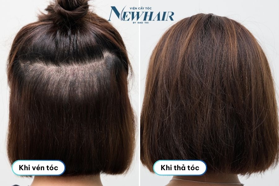 ưu điểm cấy tóc phân tầng