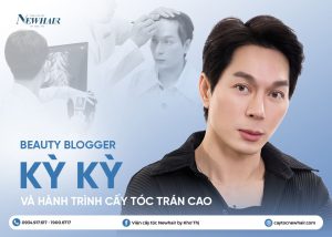 beauty blogger kỳ kỳ cấy tóc trán cao