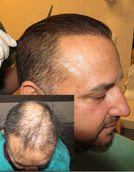 before after cấy tóc sinh học