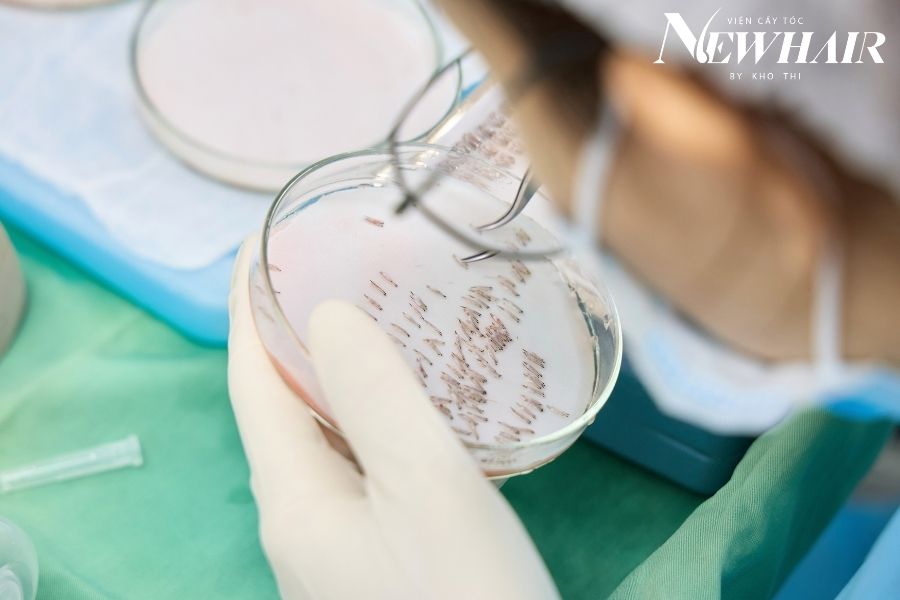 cấy tóc DHI nang ngắn