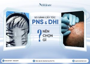cấy tóc PNS và cấy tóc DHI