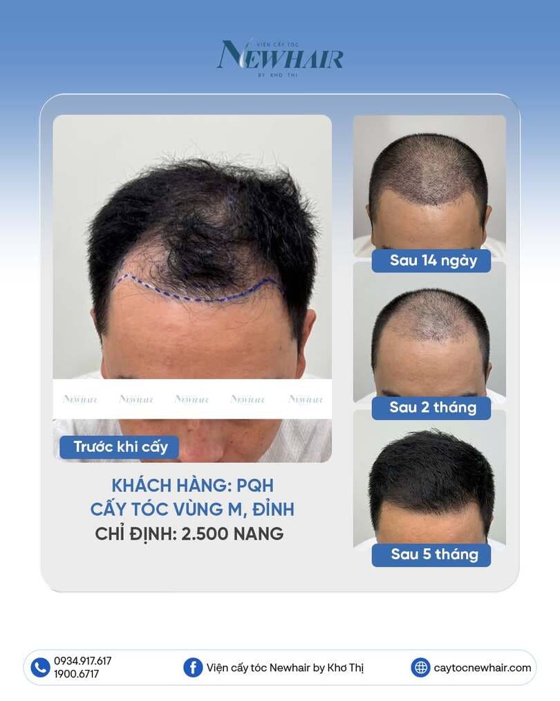 khách nam cấy tóc vùng m và đỉnh 2500 nang